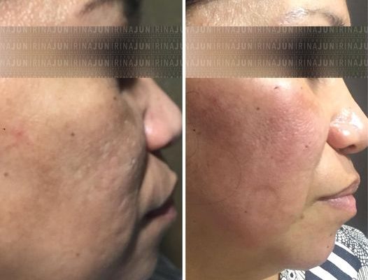 cicatrici post acne cura della pelle torino