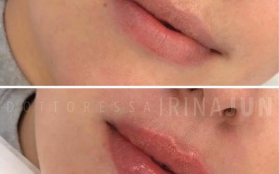 filler labbra torino dottoressa irina jun