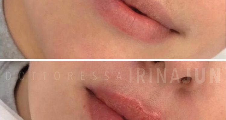 filler labbra torino dottoressa irina jun