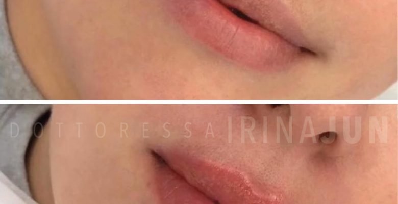 filler labbra torino dottoressa irina jun