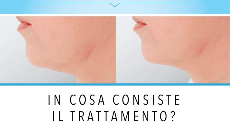 ENDOLIFT®: in cosa consiste il trattamento?