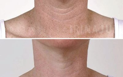 trattamento misto con Acido Ialuronico libero e peeling chimico