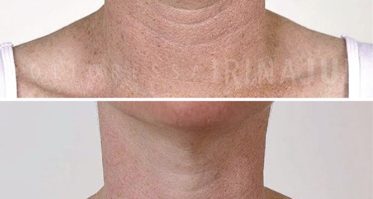 trattamento misto con Acido Ialuronico libero e peeling chimico