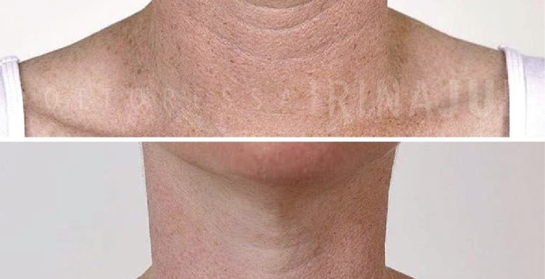 trattamento misto con Acido Ialuronico libero e peeling chimico